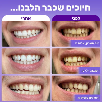 Vsmile™ - מארז ההלבנה